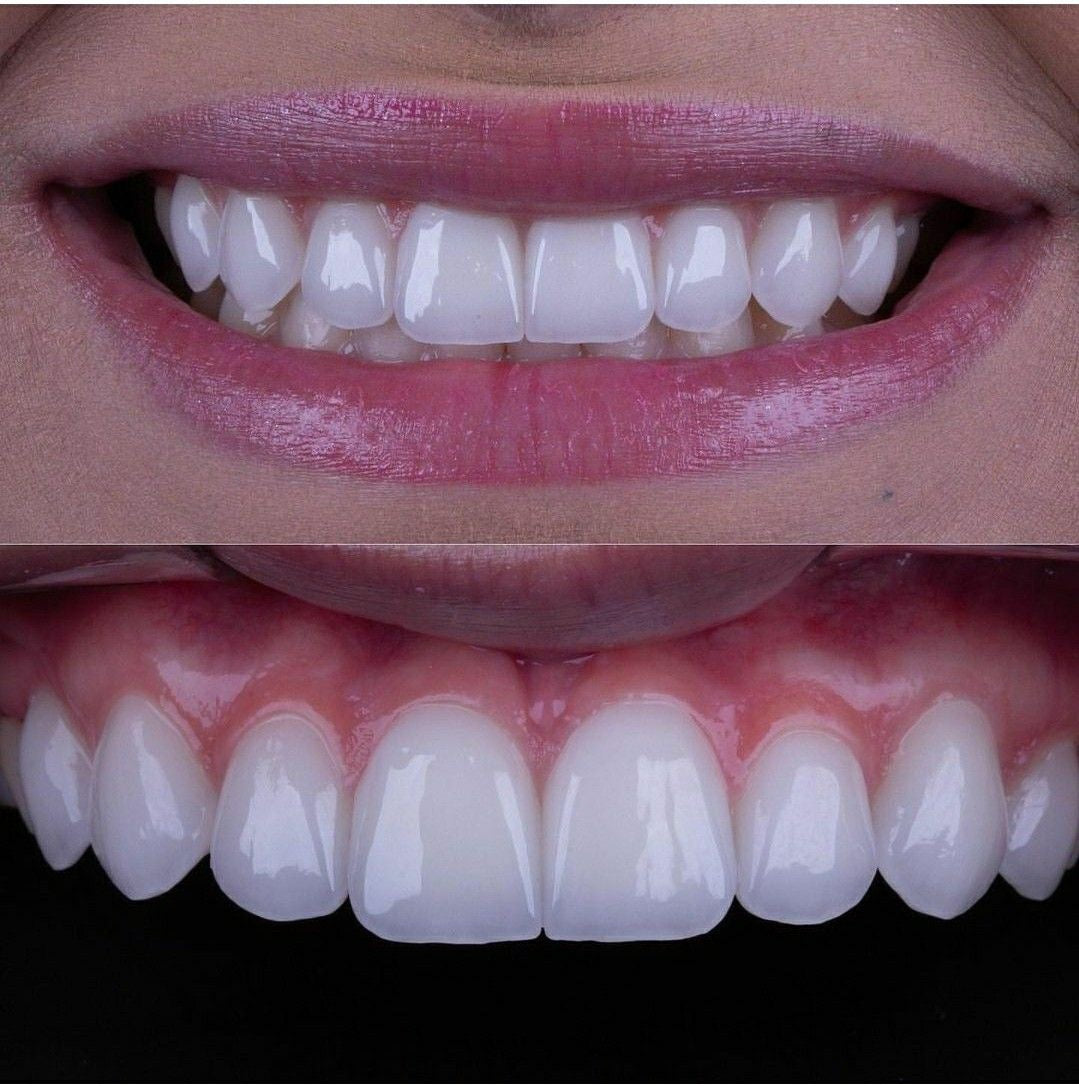 Vergonha de sorrir por causa dos seus dentes?